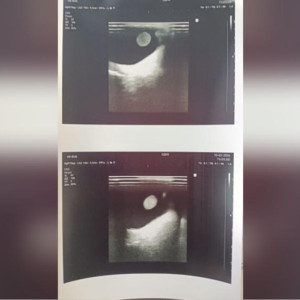 Владимирские врачи диагностировали юной пациентке редкий аутоиммунный гепатит