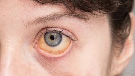 Во Владимирской области 11-летний мальчик заболел гепатитом А