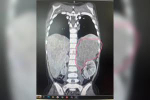 Владимирские врачи обнаружили опасную опухоль у 3-летней девочки