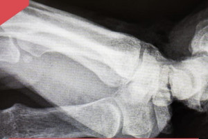 Во Владимире спасли женщину с отрезанной кистью