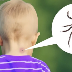 Во Владимирской области спасли ребенка от тяжелой формы болезни Лайма