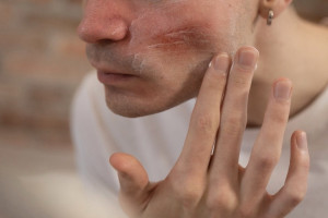 Житель Вязников откусил нос отчиму возлюбленной