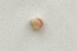 Владимирские врачи удалили камень из протока слюной железы ребенка