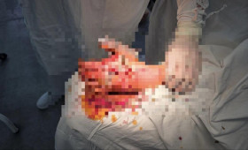 Владимирские врачи провели уникальную операцию пострадавшему от взрыва петарды ребенку