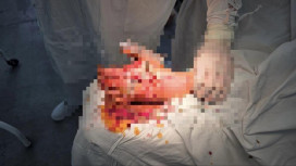 Владимирские врачи провели уникальную операцию пострадавшему от взрыва петарды ребенку