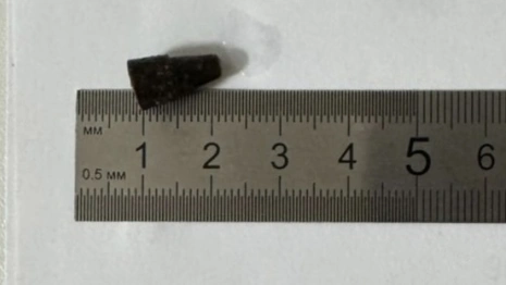 Владимирские врачи достали из бронхов пациента проглоченный 14 лет назад наконечник ручки