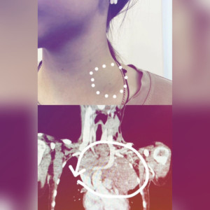 Во Владимире врачи нашли редкое заболевание у 16-летней девочки