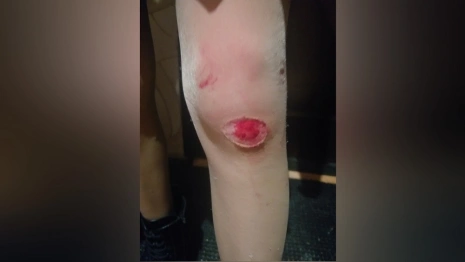 В Александрове школьница разбила ногу на скользкой дороге 