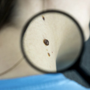 Владимирская область вошла в антирейтинг по заболеваемости раком