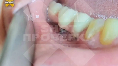 Изуродованная стоматологией женщина отсудила 3 млн рублей во Владимире