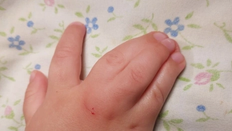 Во Владимире врачи помогши малышу со сросшимися пальцами на руках