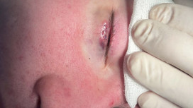 Владимирские врачи спасли ребенка с гигантским ячменем на глазу