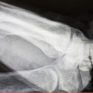 Во Владимире спасли женщину с отрезанной кистью