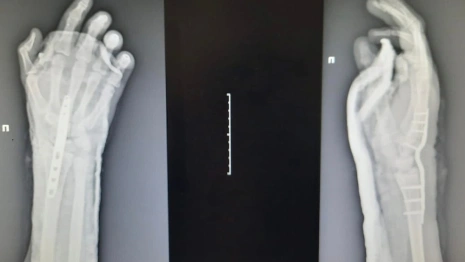 В нижегородской клинике рассказали о подростке из Коврова, отрубившем себе кисть