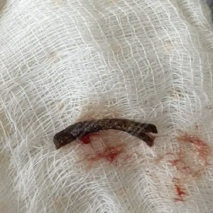 Владимирские врачи удалили из бронхов мужчины куриную кость