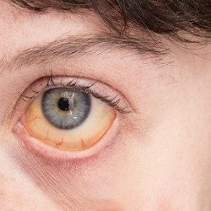 Во Владимирской области 11-летний мальчик заболел гепатитом А