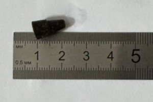 Владимирские врачи достали из бронхов пациента проглоченный 14 лет назад наконечник ручки