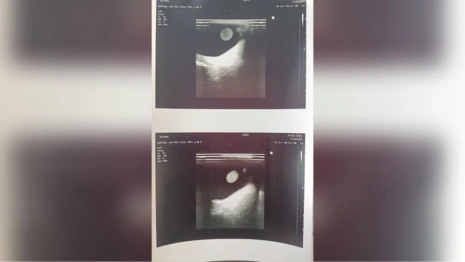 Владимирские врачи диагностировали юной пациентке редкий аутоиммунный гепатит