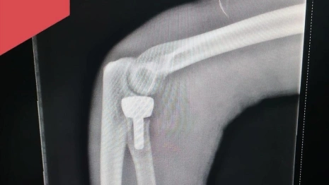 В Александровской больнице впервые поставили эндопротез локтевого сустава пациенту