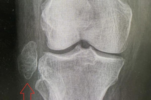 Владимирские врачи удалили опухоль размером с куриное яйцо из коленного сустава пациентки