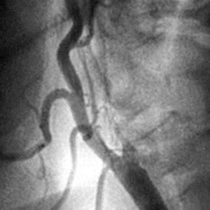 Во Владимире врачи спасли девочку с бактериальным менингитом