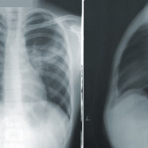 В Коврове больной туберкулезом экс-заключенный отказался от лечения 
