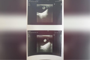 Владимирские врачи диагностировали юной пациентке редкий аутоиммунный гепатит