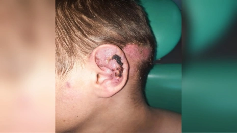 Владимирские врачи спасли ухо сбитому машиной 13-летнему мальчику