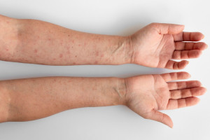 В Гусь-Хрустальном доме ребенка дети заболели корью