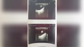 Владимирские врачи диагностировали юной пациентке редкий аутоиммунный гепатит