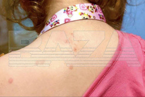 Во Владимире снова зафиксировали случаи заражения вирусом Коксаки