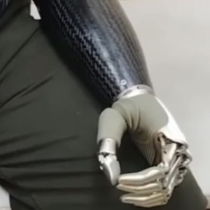 Лишившемуся руки на производстве жителю Владимира установили протез за 3,3 млн рублей