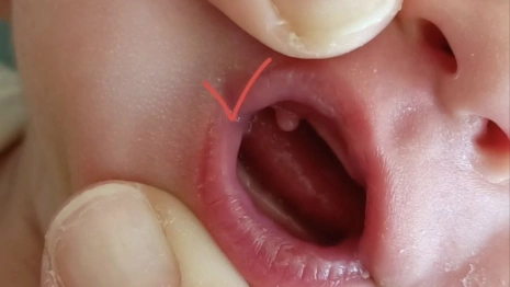 Владимирские врачи удалили новорожденному малышу опухоль во рту