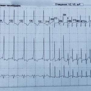 Владимирские врачи стали чаще выявлять феномен WPW у детей
