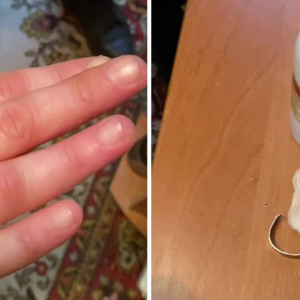 В Коврове спасатели помогли вызволить палец женщины из кольца