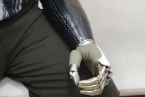 Лишившемуся руки на производстве жителю Владимира установили протез за 3,3 млн рублей