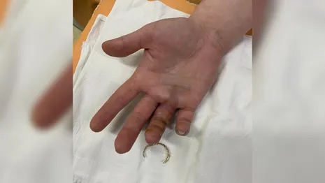 В Коврове освободили сломанный палец от обручального кольца