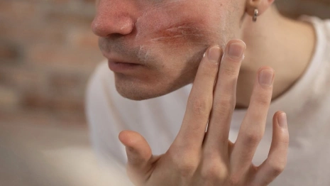 Житель Вязников откусил нос отчиму возлюбленной