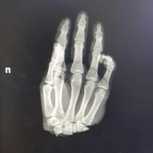 Во Владимирской области 16-летний подросток отрубил себе кисть