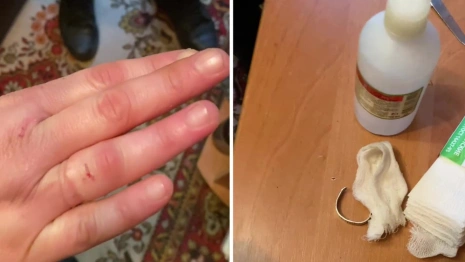 В Коврове спасатели помогли вызволить палец женщины из кольца