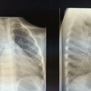 Во Владимире медики спасли малыша со скоплением гноя в легких