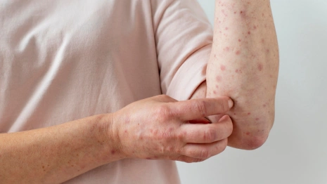 Очаги кори обнаружили в двух районах Владимирской области