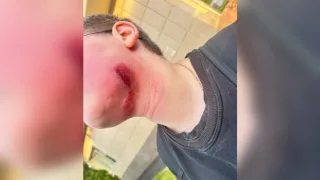 В Муроме ребенок едва не погиб из-за натянутой между деревьями веревки