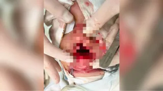 Владимирские врачи спасли ребенка с серьезной травмой лица